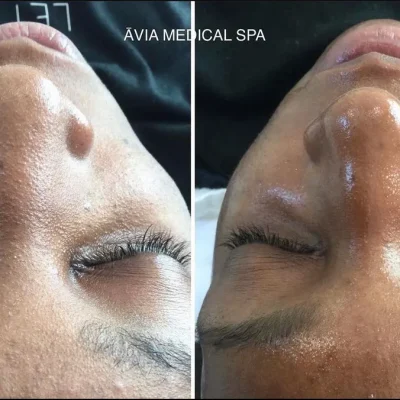 HydraFacial-before-and-after by Avia Medical Spa in the United States