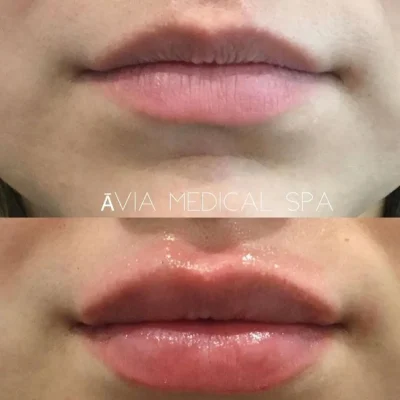 Lip-Filler-2 by Avia Medical Spa in the United States