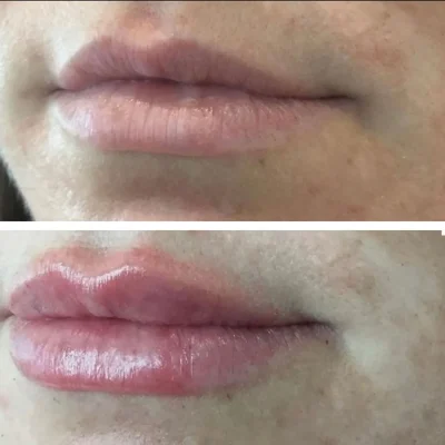 Lip-Filler-4 by Avia Medical Spa in the United States