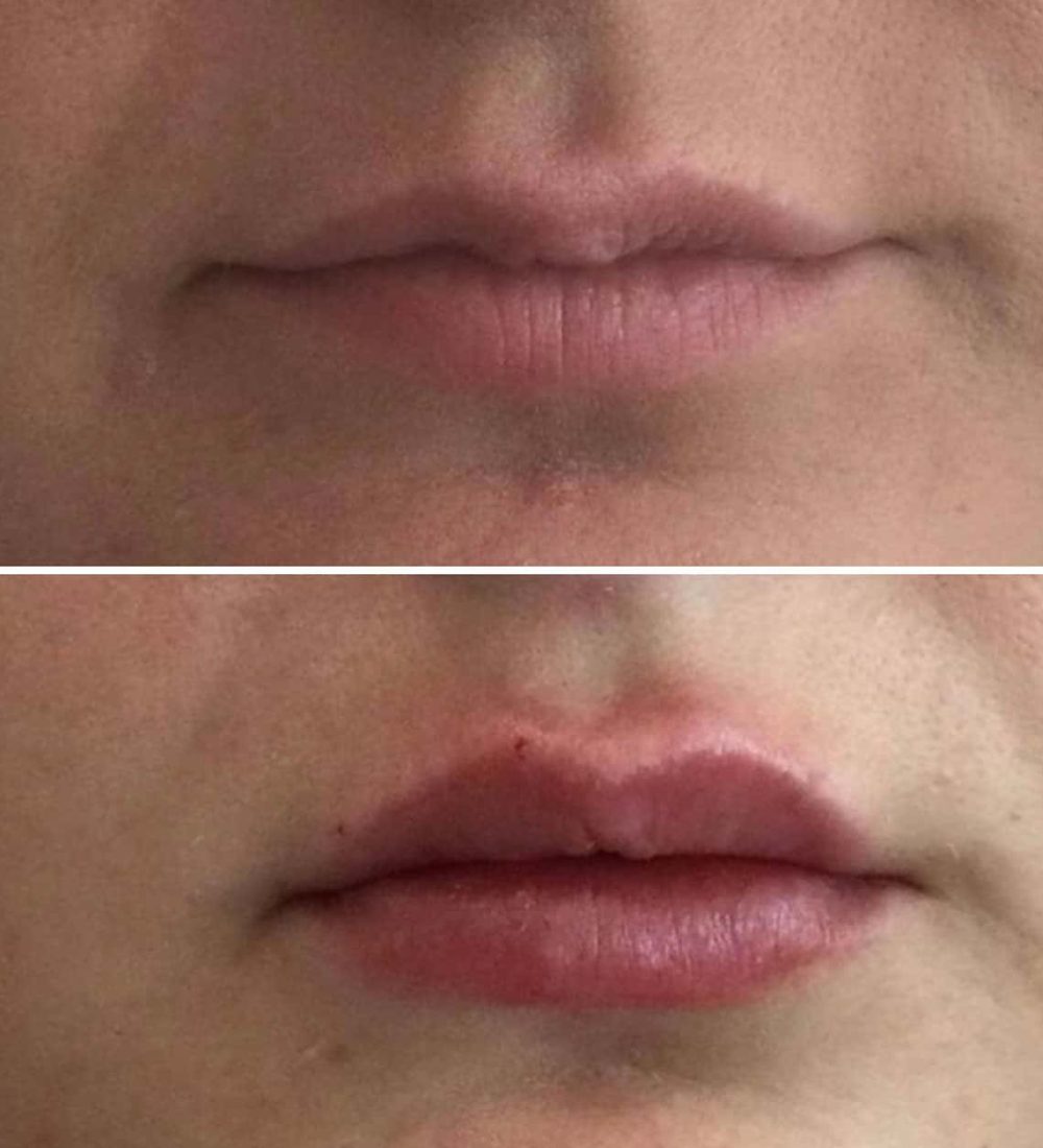Lip-Filler-7 by Avia Medical Spa in the United States