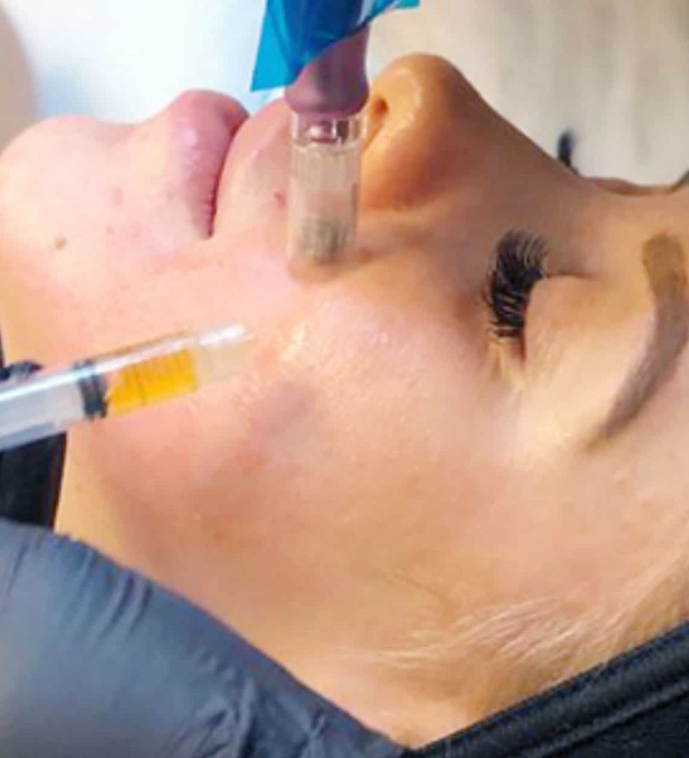 Microneedling-Facial-with-PRP-2 by Avia Medical Spa in the United States