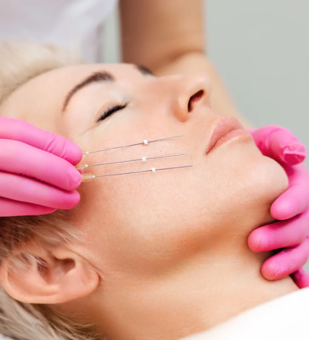 PDO Threads Nonsurgical Minimally Invasive Face-Lift one by Avia Medical Spa in the United States