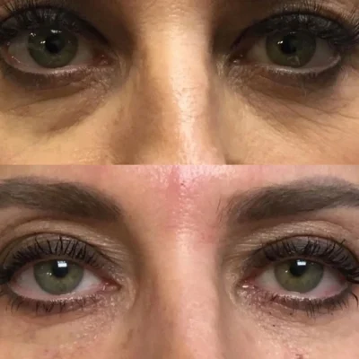 Under-Eye-Filler-1 by Avia Medical Spa in the United States