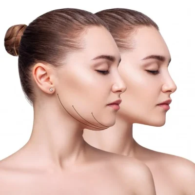 a.Kybella by Avia Medical Spa in the United States