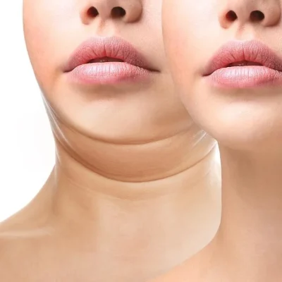 a.Kybella2 by Avia Medical Spa in the United States