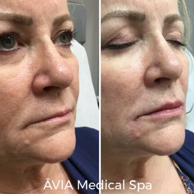 image29 by Avia Medical Spa in united states