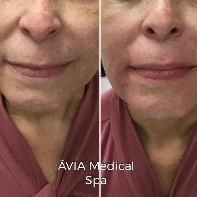 image30 by Avia Medical Spa in united states