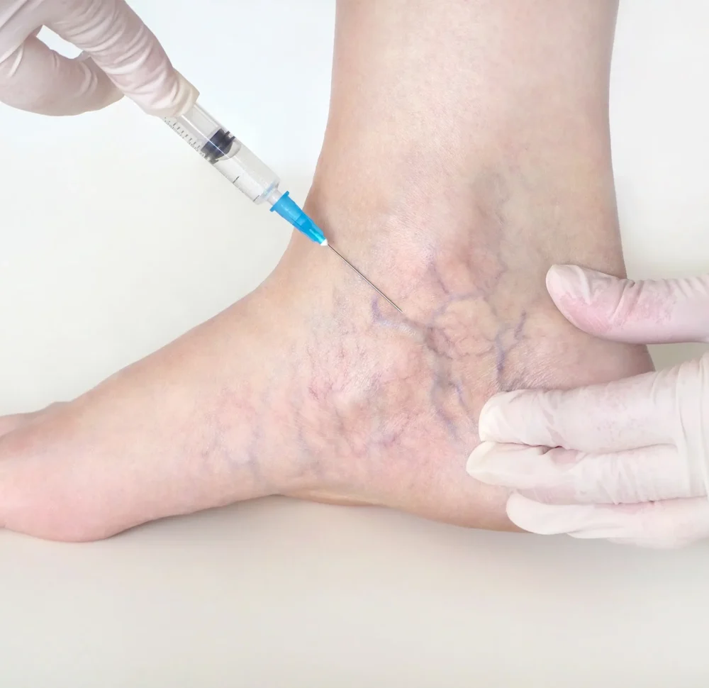vein removal two by Avia Medical Spa in the United States