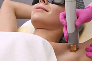 Laser-Hair-Removal-2
