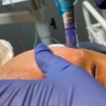 Microneedling-Facial-1 by Avia Medical Spa in the United States