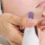 Microneedling-Facial-2 by Avia Medical Spa in the United States