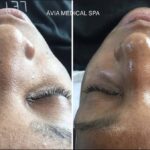 HydraFacial before and after by Avia Medical Spa in the United States