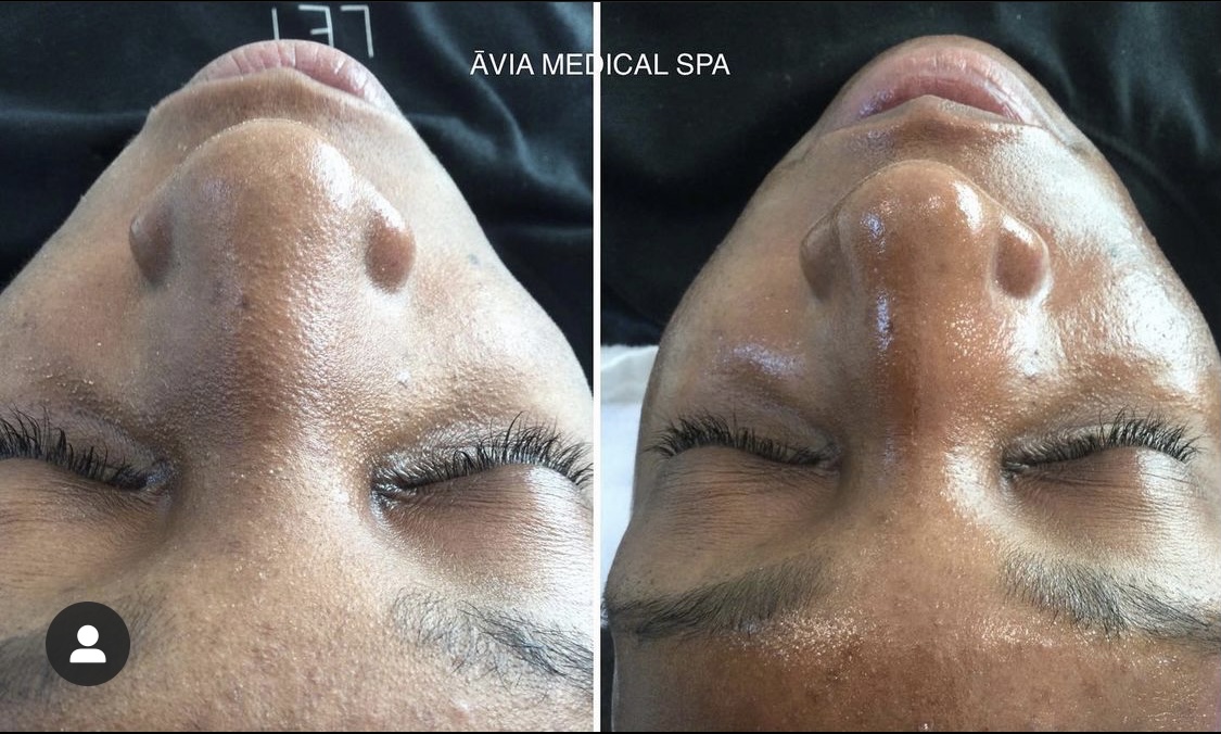 HydraFacial before and after
