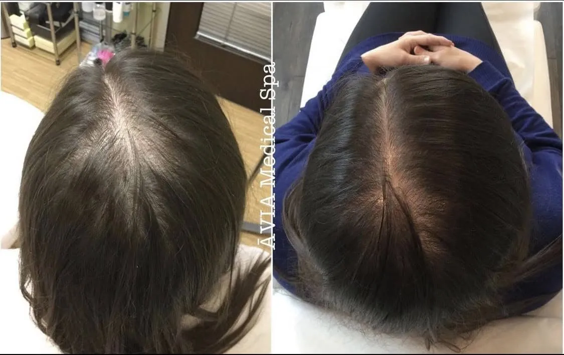 Results-after-2-sessions-of-PRP