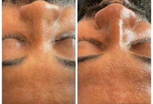 hydrafacial-results-3