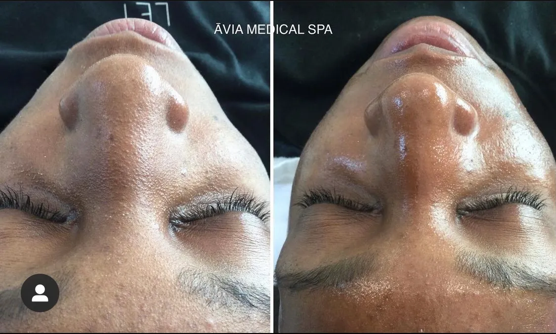 HydraFacial-before-and-after by Avia Medical Spa in the United States