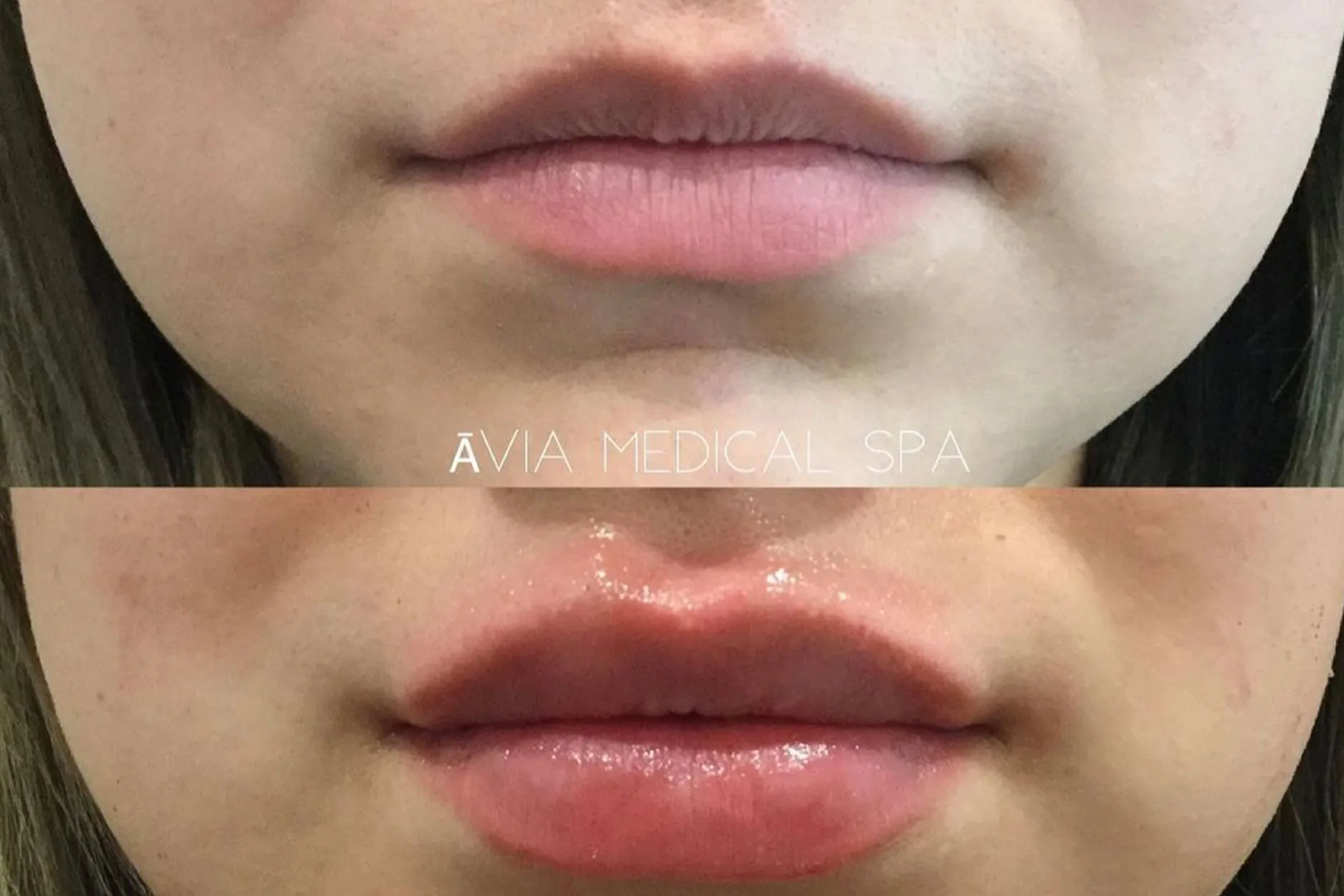 Lip-Filler-2 by Avia Medical Spa in the United States