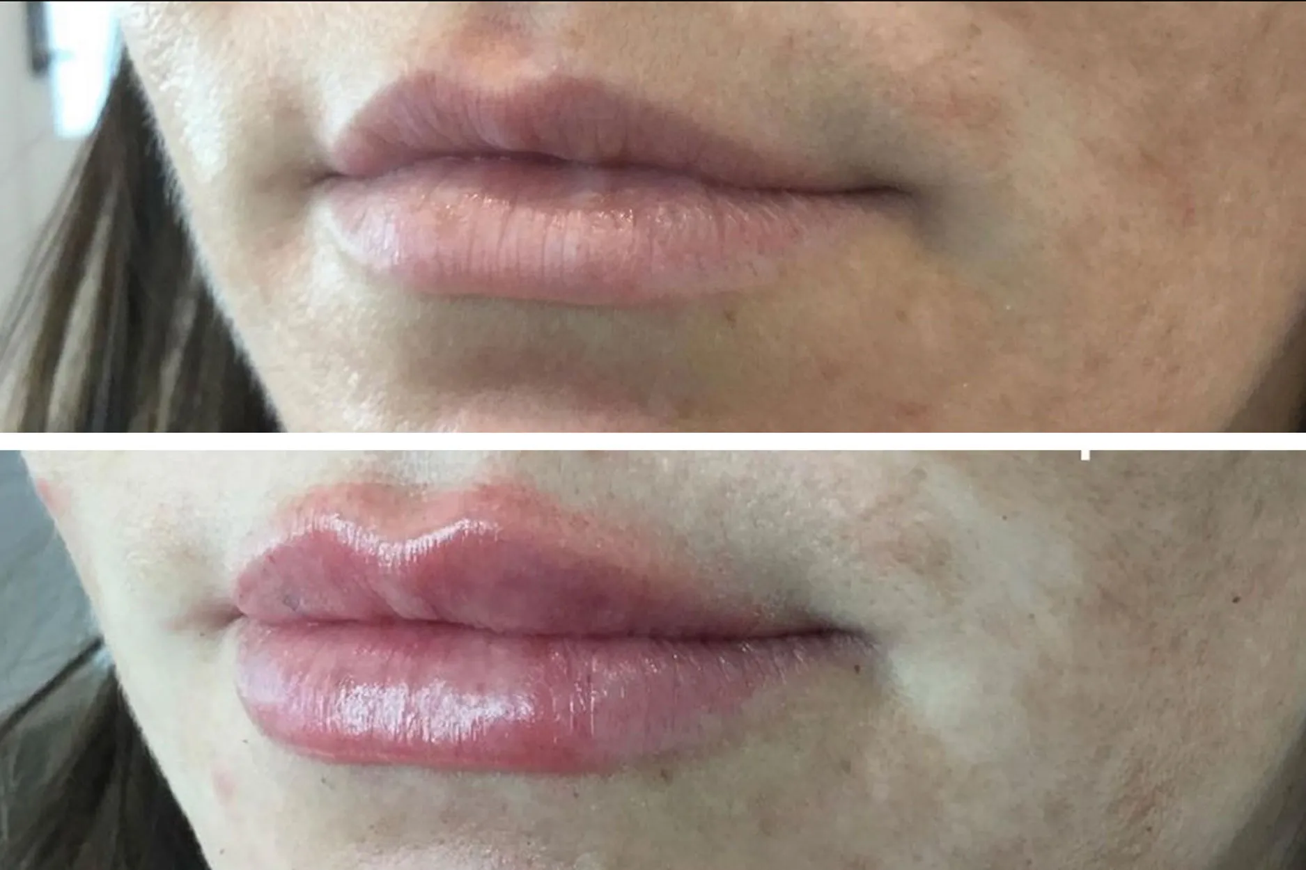 Lip-Filler-4 by Avia Medical Spa in the United States