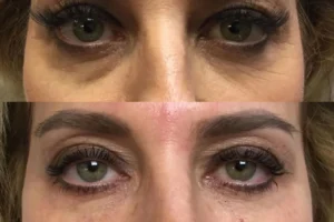 Under-Eye-Filler-1