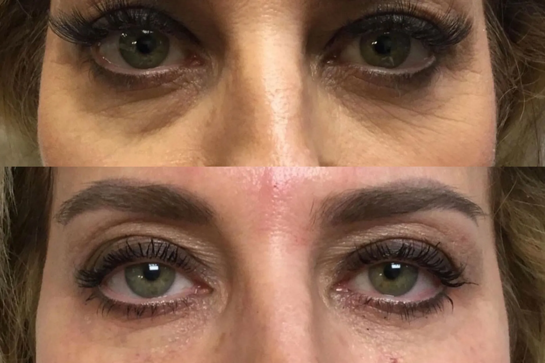 Under-Eye-Filler-1 by Avia Medical Spa in the United States