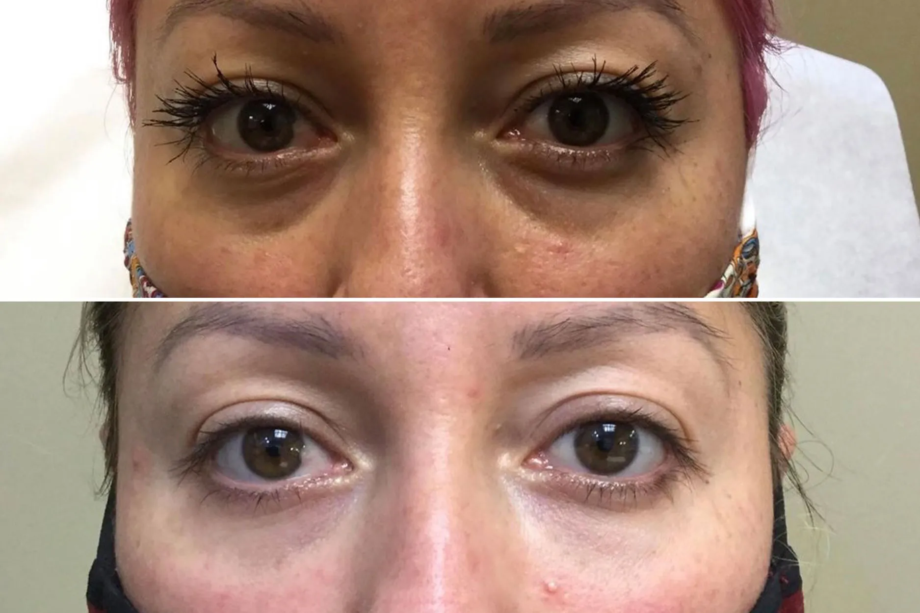 Under-Eye-Filler-2 by Avia Medical Spa in the United States