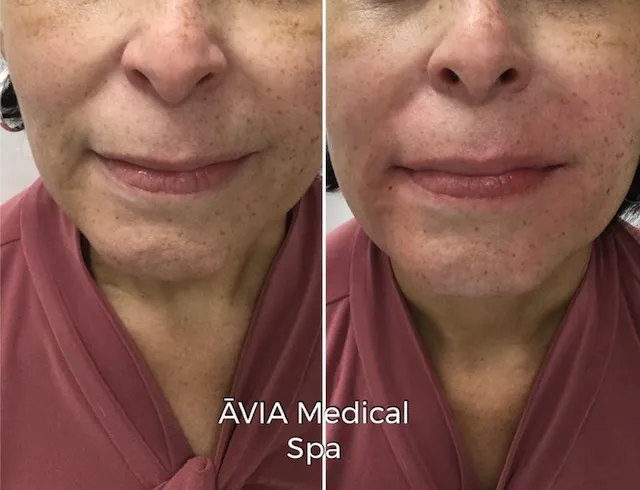 image30 by Avia Medical Spa in united states