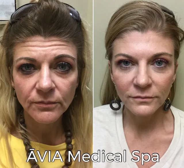 image31 by Avia Medical Spa in united states