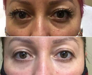 1_0000_Under-Eye-Filler-2