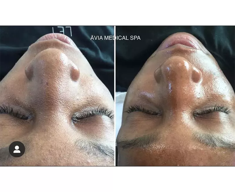 1_0030_HydraFacial-before-and-after