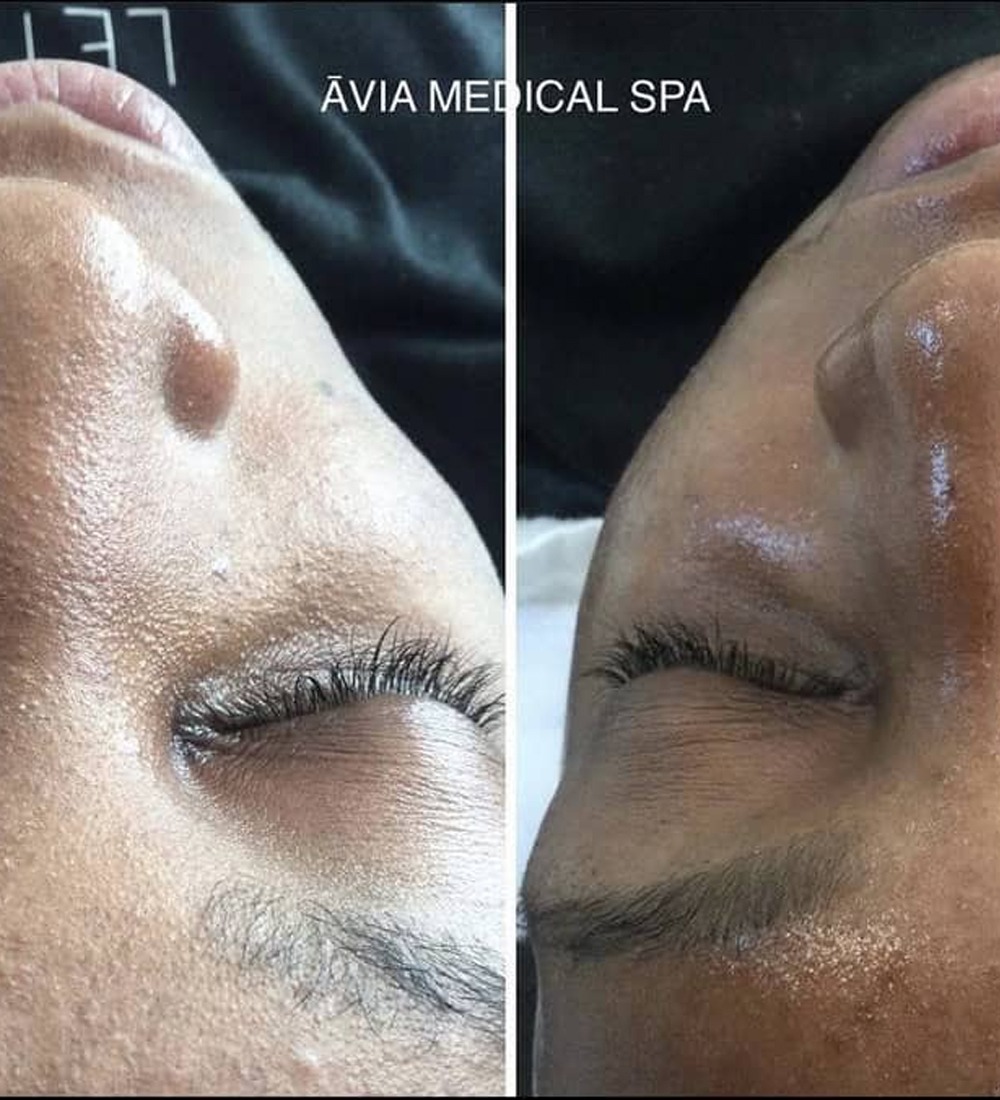 HydraFacial-before-and-after