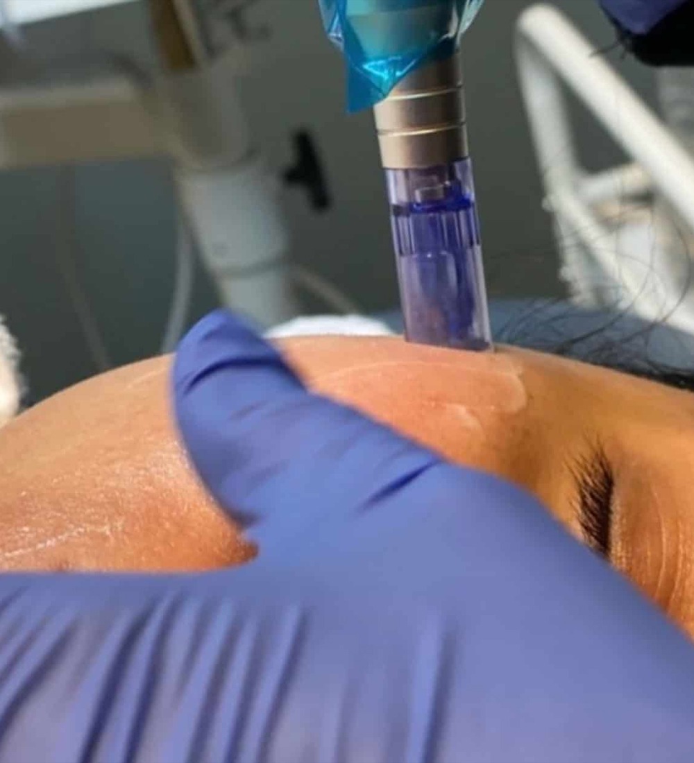 Microneedling-Facial (2)