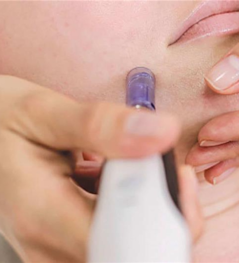 Microneedling-Facial