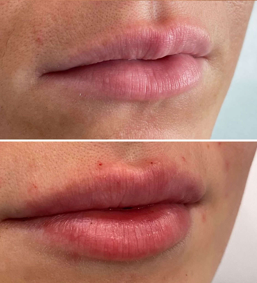 Lip-Filler-1