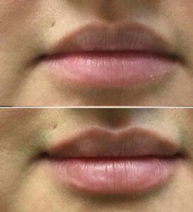 Lip-Filler-3