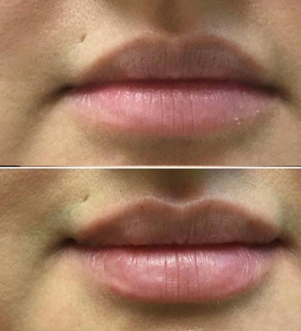 Lip-Filler-3