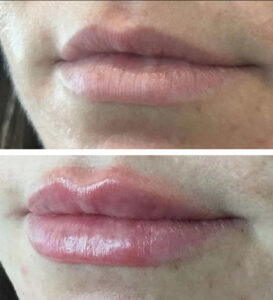 Lip-Filler-4