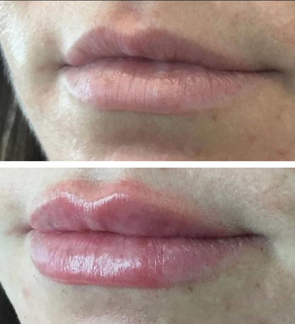 Lip-Filler-4