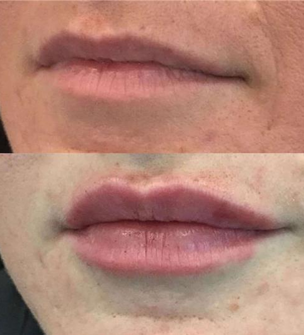 Lip-Filler-5