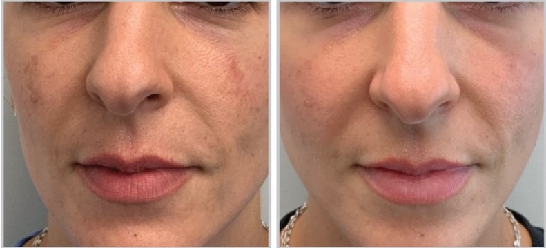 MOXI Before and After