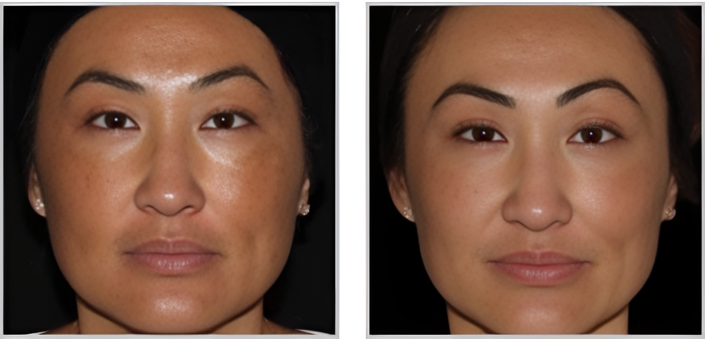 MOXI Treatment Results Before and After