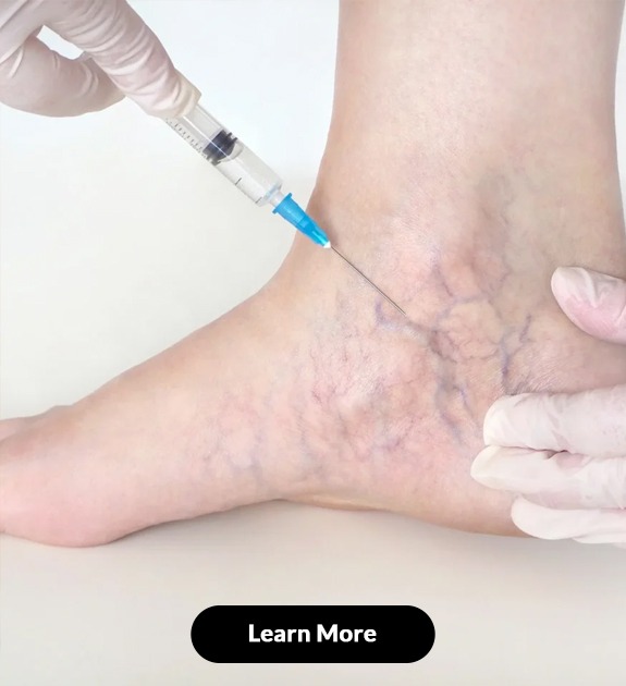 Vein Removal Treatment