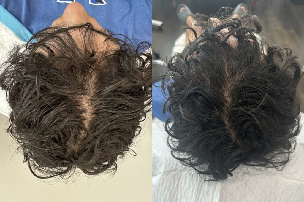 Hair Restoration