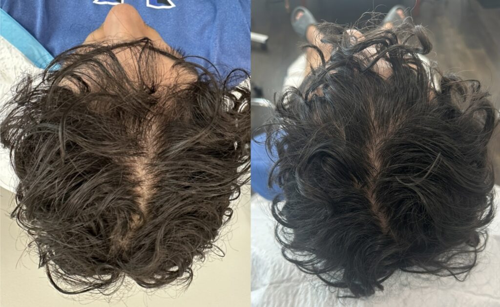 Hair Restoration