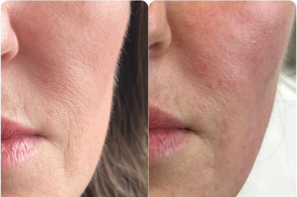 SkinVive Treatment Before After 02 resized