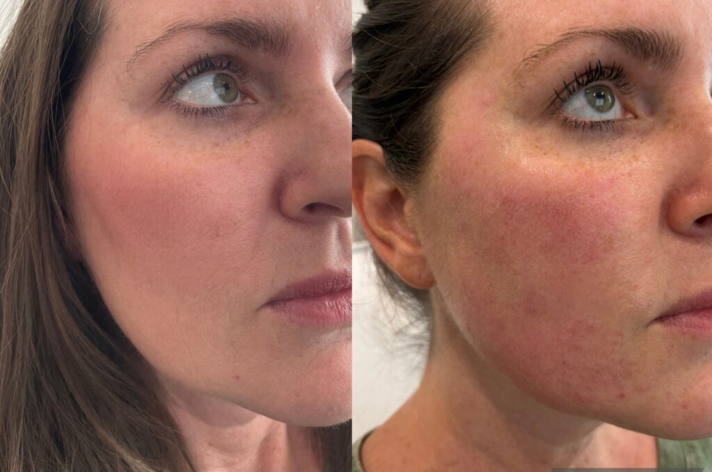 SkinVive Treatment Before After (2)