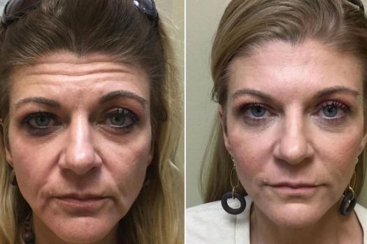 Full-Face-Rejuvenation-with-Facial-Fillers-and-Neurotoxin