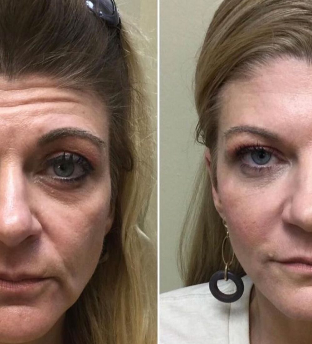 Full-Face-Rejuvenation-with-Facial-Fillers-and-Neurotoxin