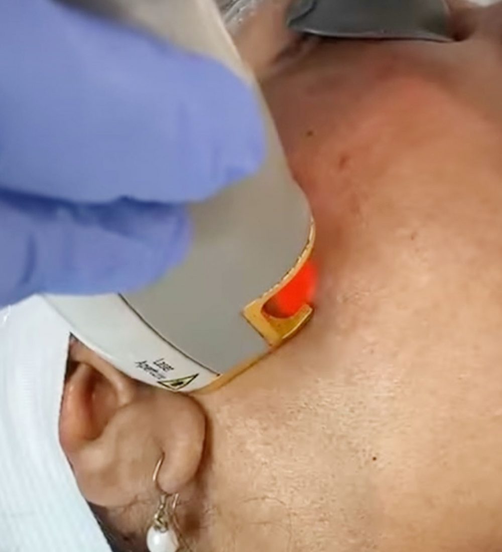 Laser-Hair-Removal-1-1-pm20tcv3c6f2fr7zc65xx3cuymgqnjamo5w6vazq48