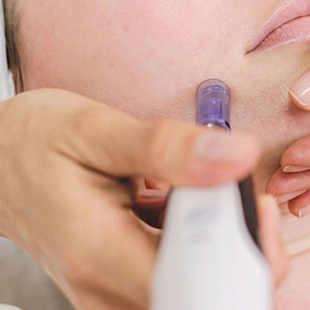 Microneedling-Facial-2