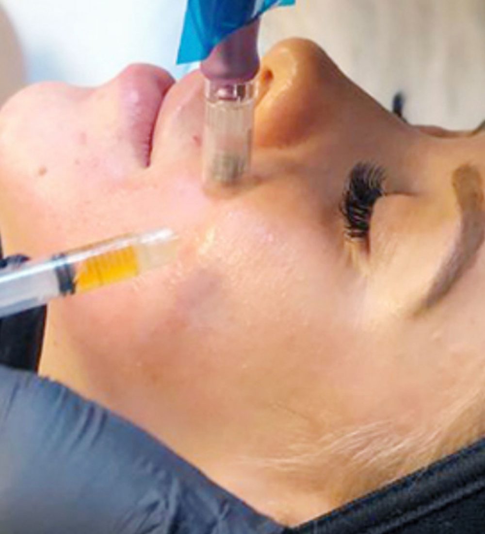 Microneedling-Facial-with-PRP-2